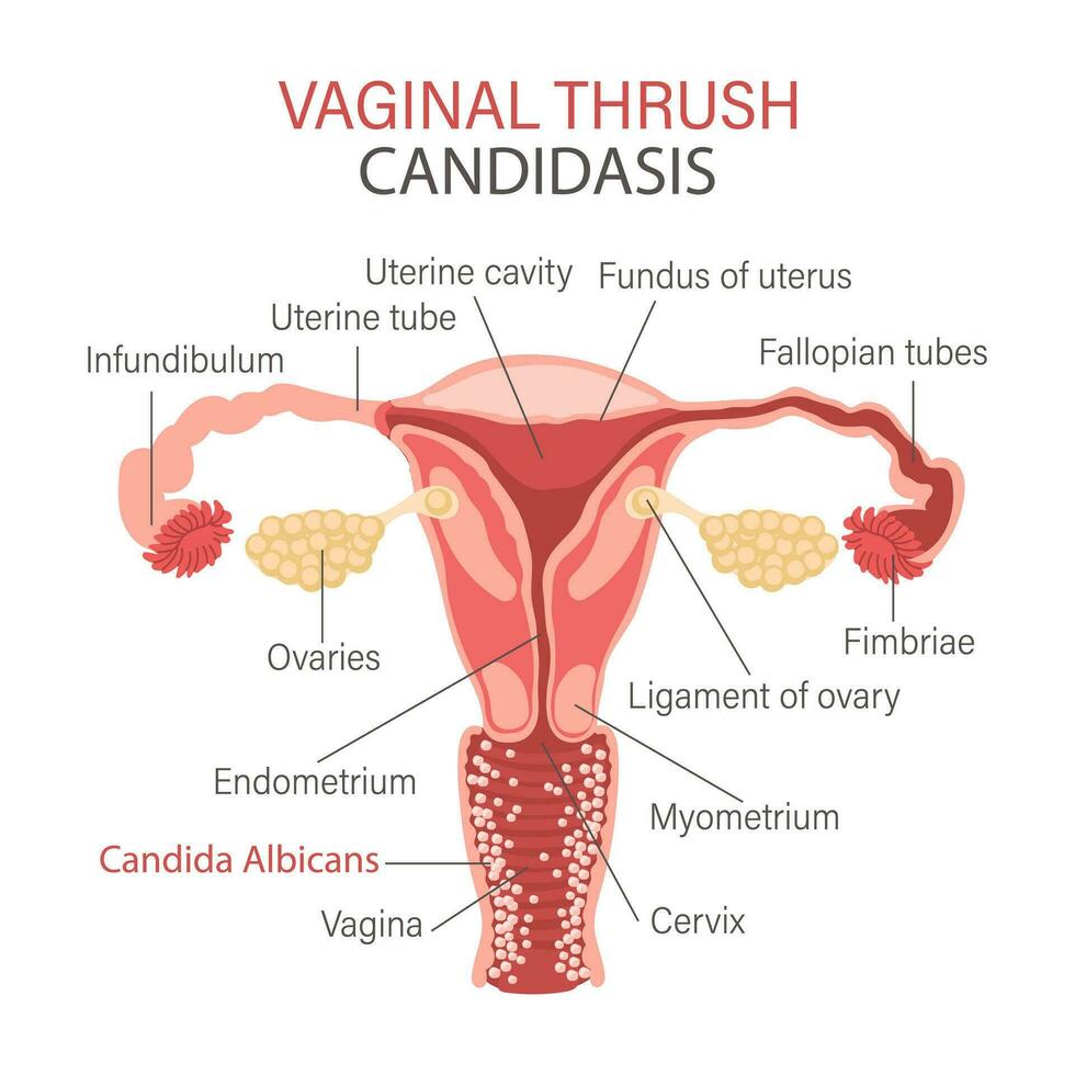 vaginale fungine infezione. candidosi. infografica di ginecologico malattie. ginecologia. medicinale. Infografica striscione, vettore. vettore