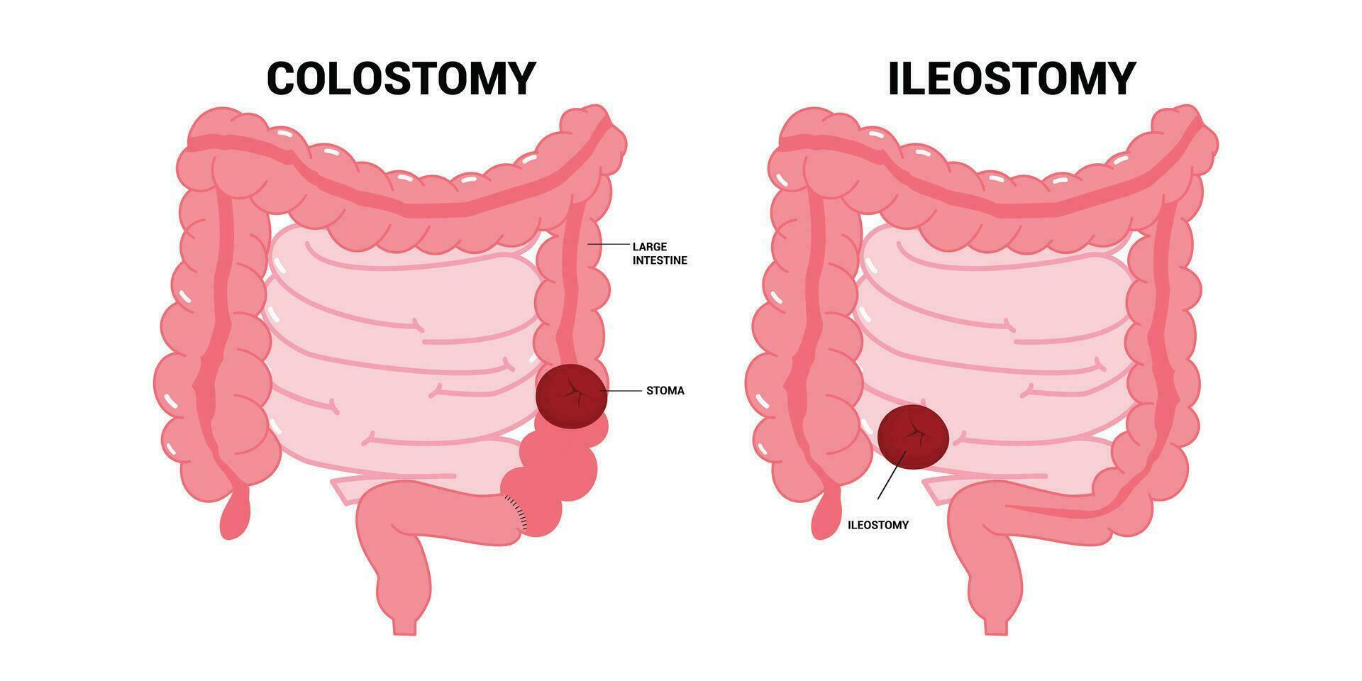 il ileo stoma addome marsupio per bloccato cacca sgabello sistema di piccolo grande colon con crohn e hirschsprung malattia infiammazione chirurgia ernia cancro tratto rettale tumore ciclo continuo dilagante rimozione vettore