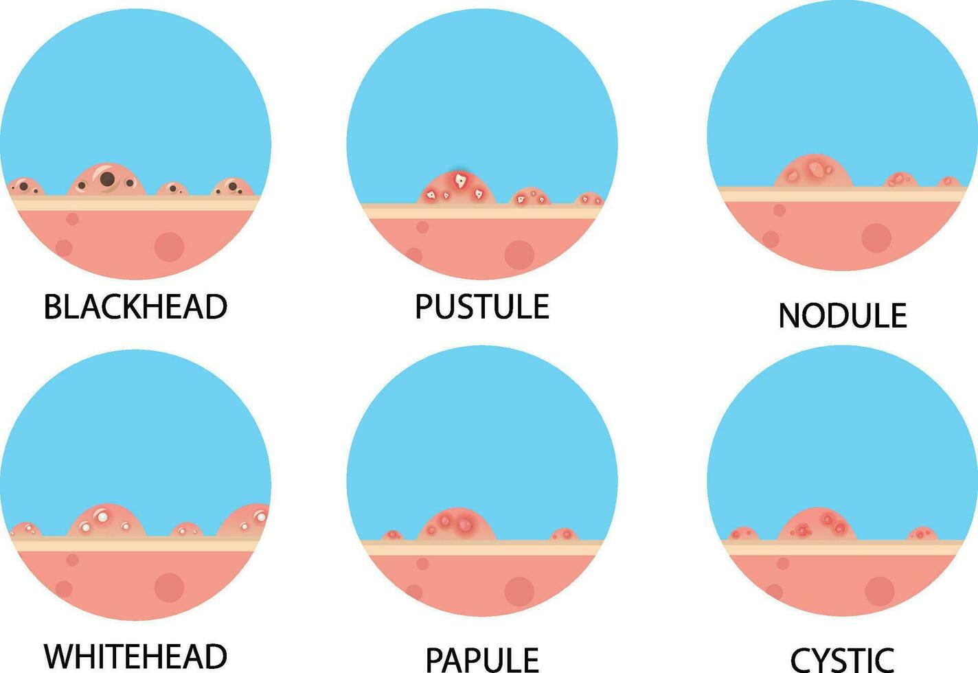 vettore collezione di tipi di brufoli dentro il pelle facciale infezioni, brufoli e pelle infiammazione. cura della pelle, viso acne scoppiare. dermatologia epidermide