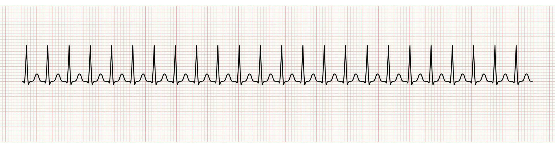 ekg tenere sotto controllo mostrando sopraventricolare tachicardia vettore