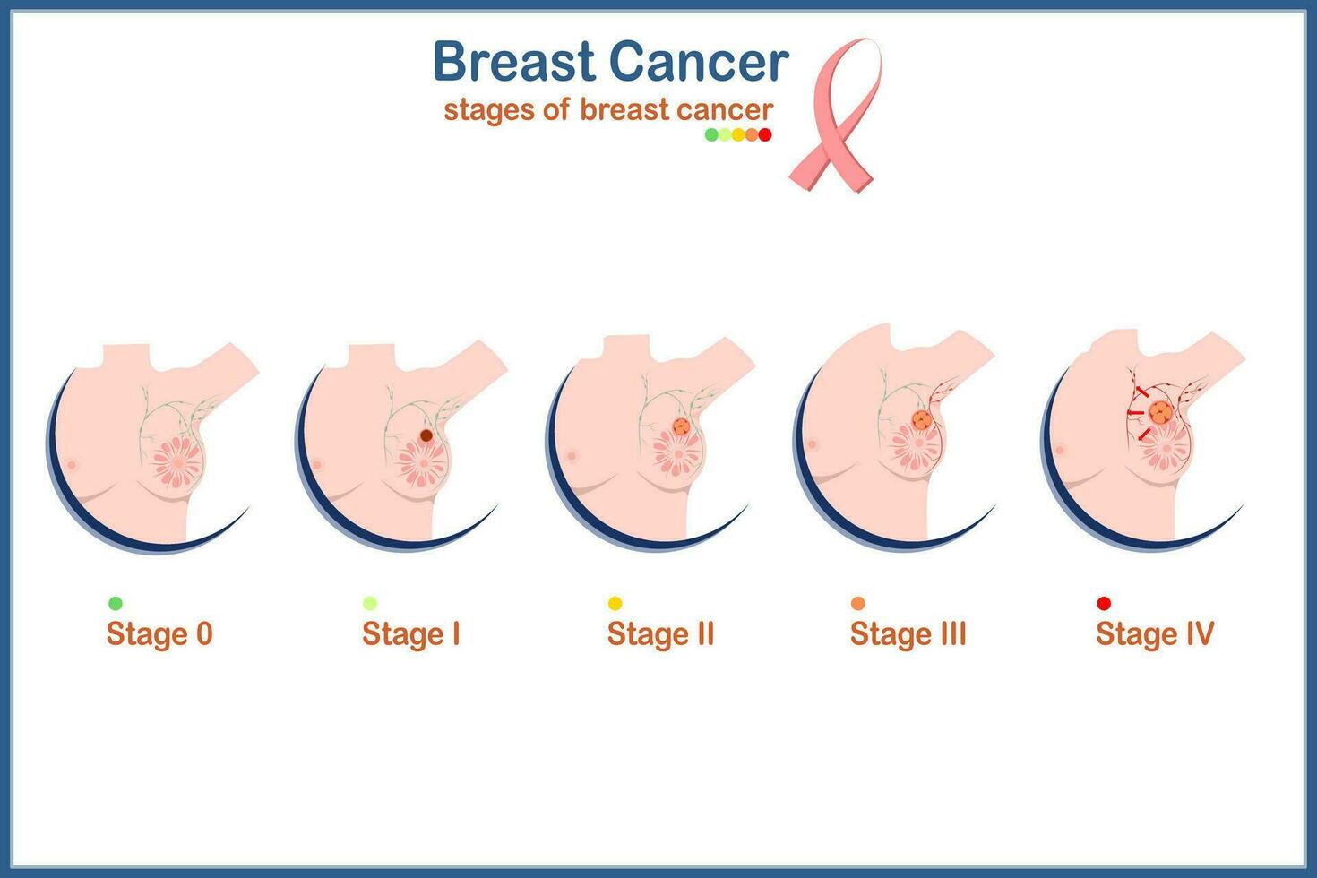 medico illustrazione vettore concetto, femmina seni e quattro livelli di Seno cancro gravità.isolata su bianca sfondo, piatto stile.