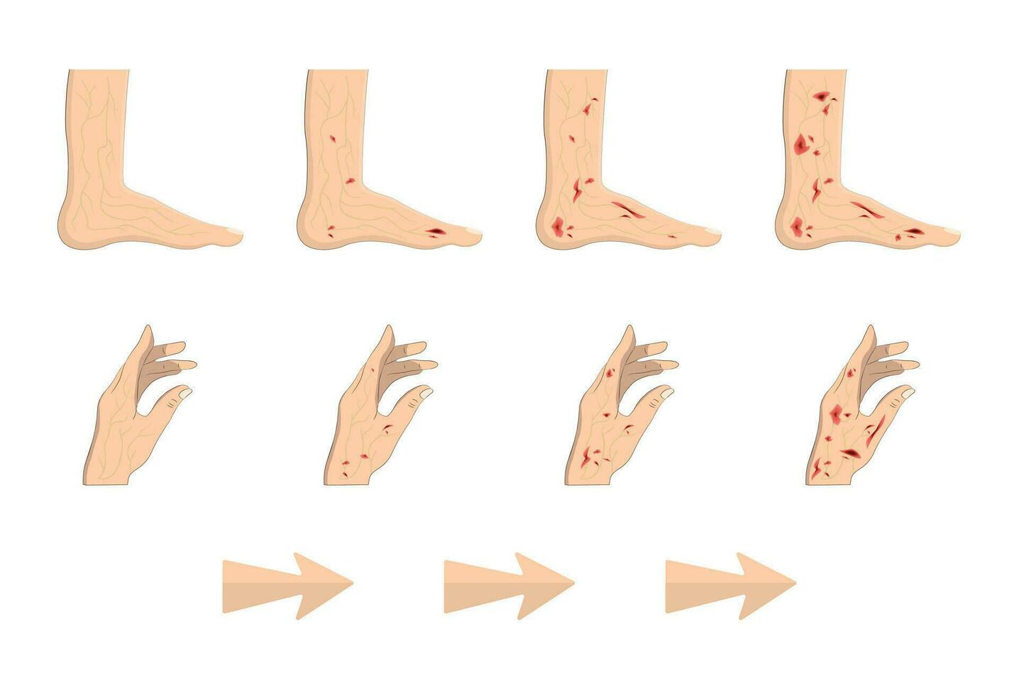 diabetico, zucchero piedi vettore illustrazione