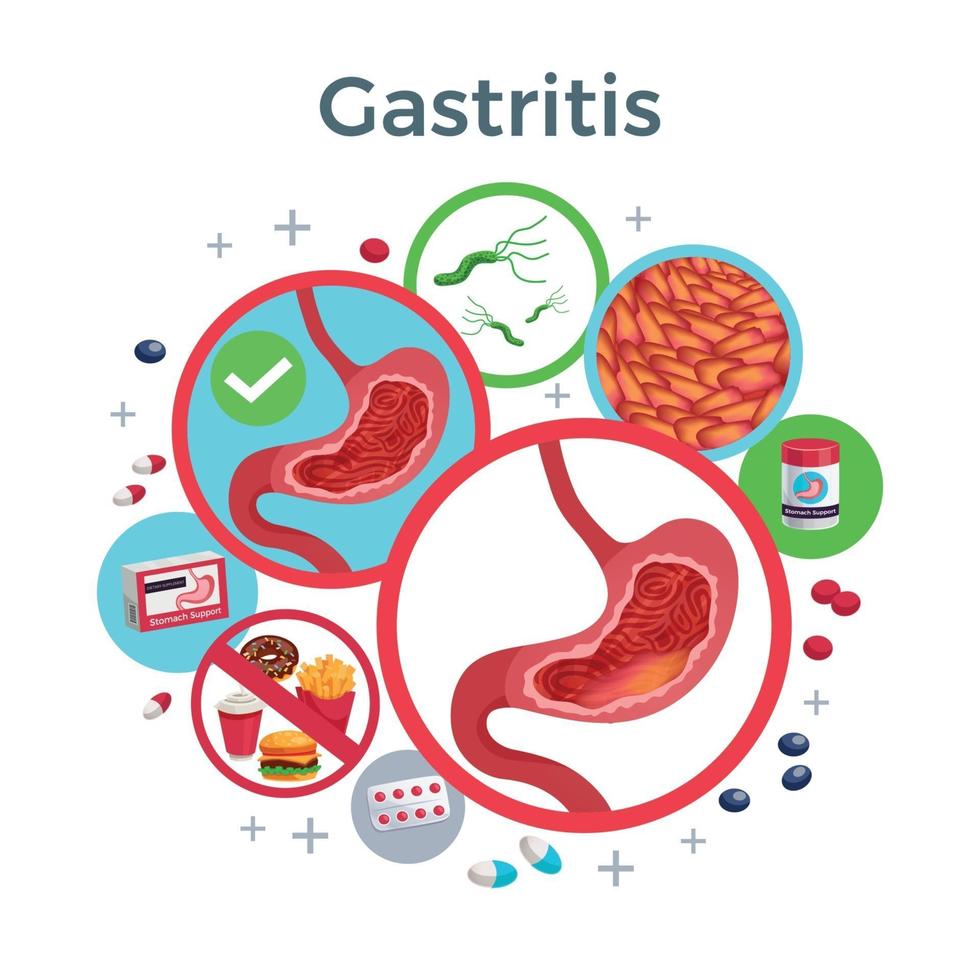 illustrazione vettoriale di composizione piatta gastrite