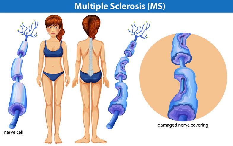 Un&#39;anatomia umana della sclerosi multipla vettore