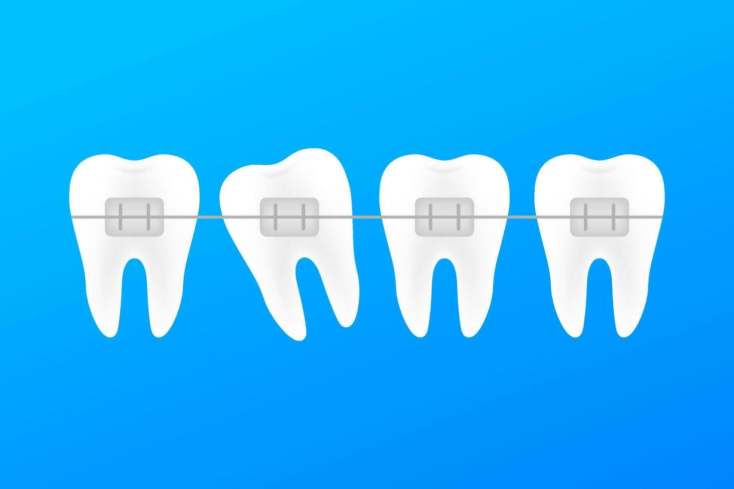 correzione di denti con ortodontico bretelle. stadi di denti allineamento. dentale clinica Servizi. vettore azione illustrazione.