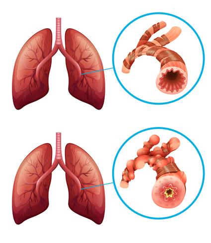 Diagramma che mostra i polmoni con la malattia vettore