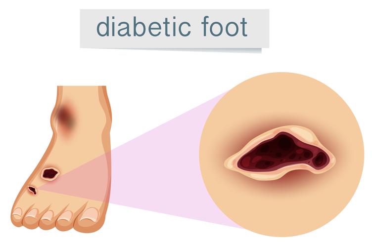 Un piede umano con diabetico vettore