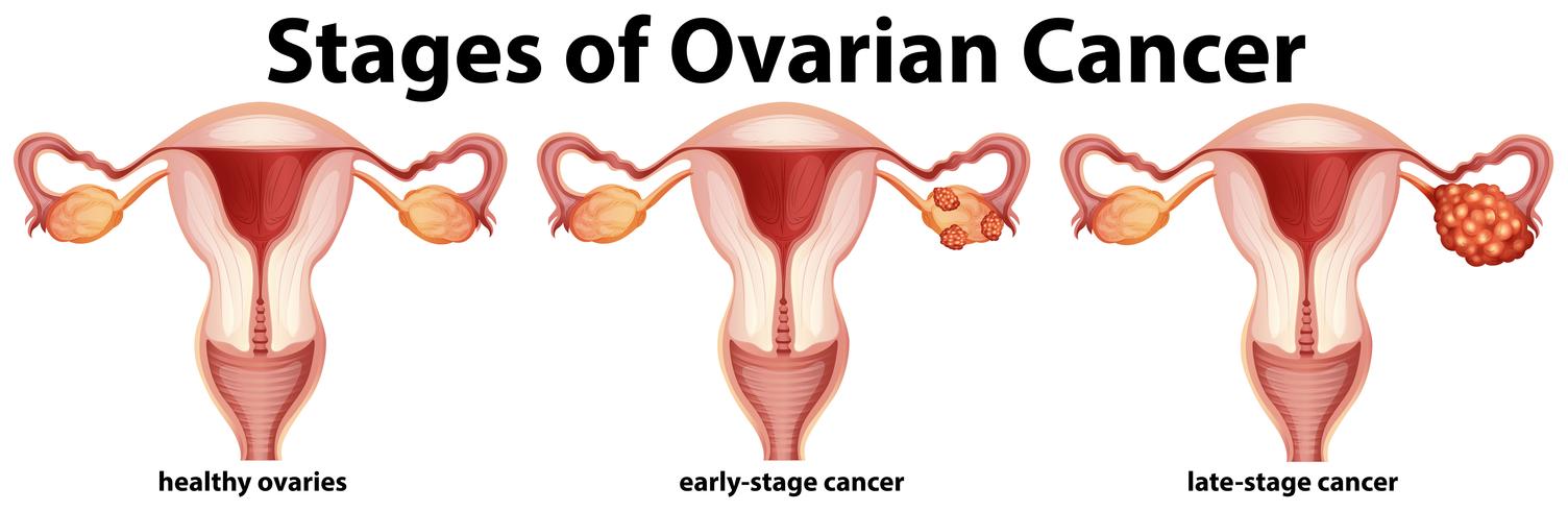 Diagramma che mostra le fasi del cancro ovarico vettore