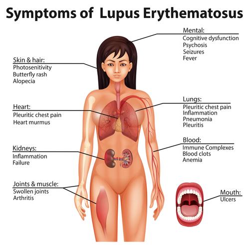 Sintomi di anatomia umana di lupus eritematoso vettore