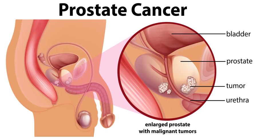 Diagramma del cancro alla prostata vettore