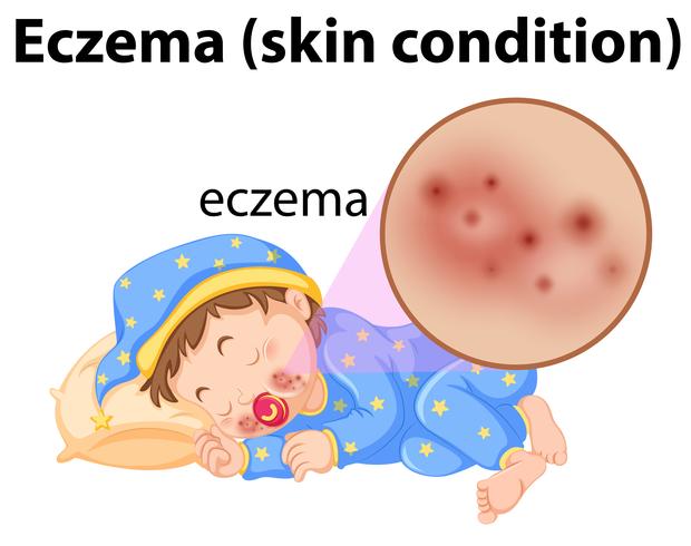 Un bambino che ha Eczema sul viso vettore