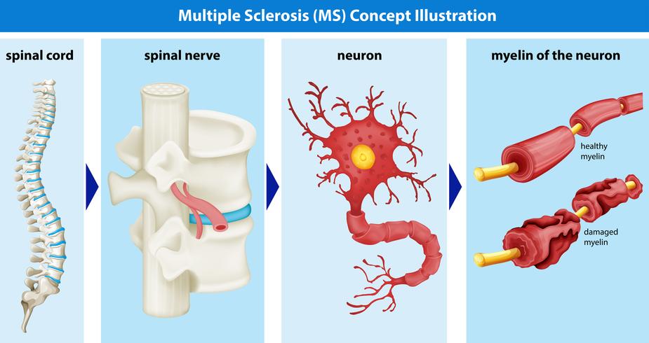 Diagramma che mostra il concetto di sclerosi multipla vettore