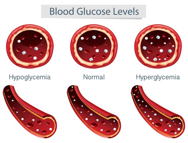 3 diversi livelli di glucosio nel sangue vettore