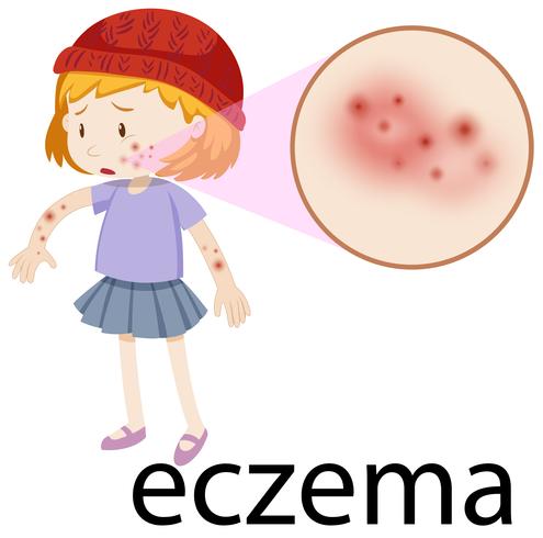 Bambino con eczema ingrandito vettore