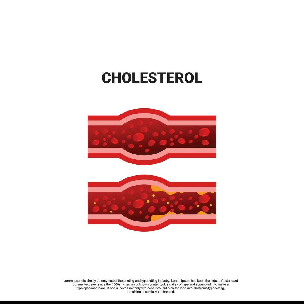 coronario arteria malattia è il costruire di placca nel il arterie quello fornitura ricco di ossigeno sangue per il tuo cuore. placca cause un' strozzatura o blocco quello poteva risultato nel un' cuore attacco vettore