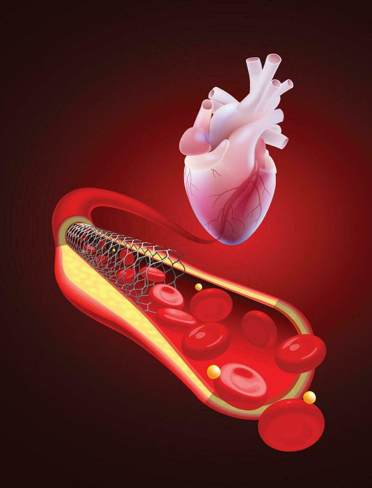 3d illustrazione di un' umano coronario arteria con normale sangue flusso dopo angioplastica con un' stent. vettore