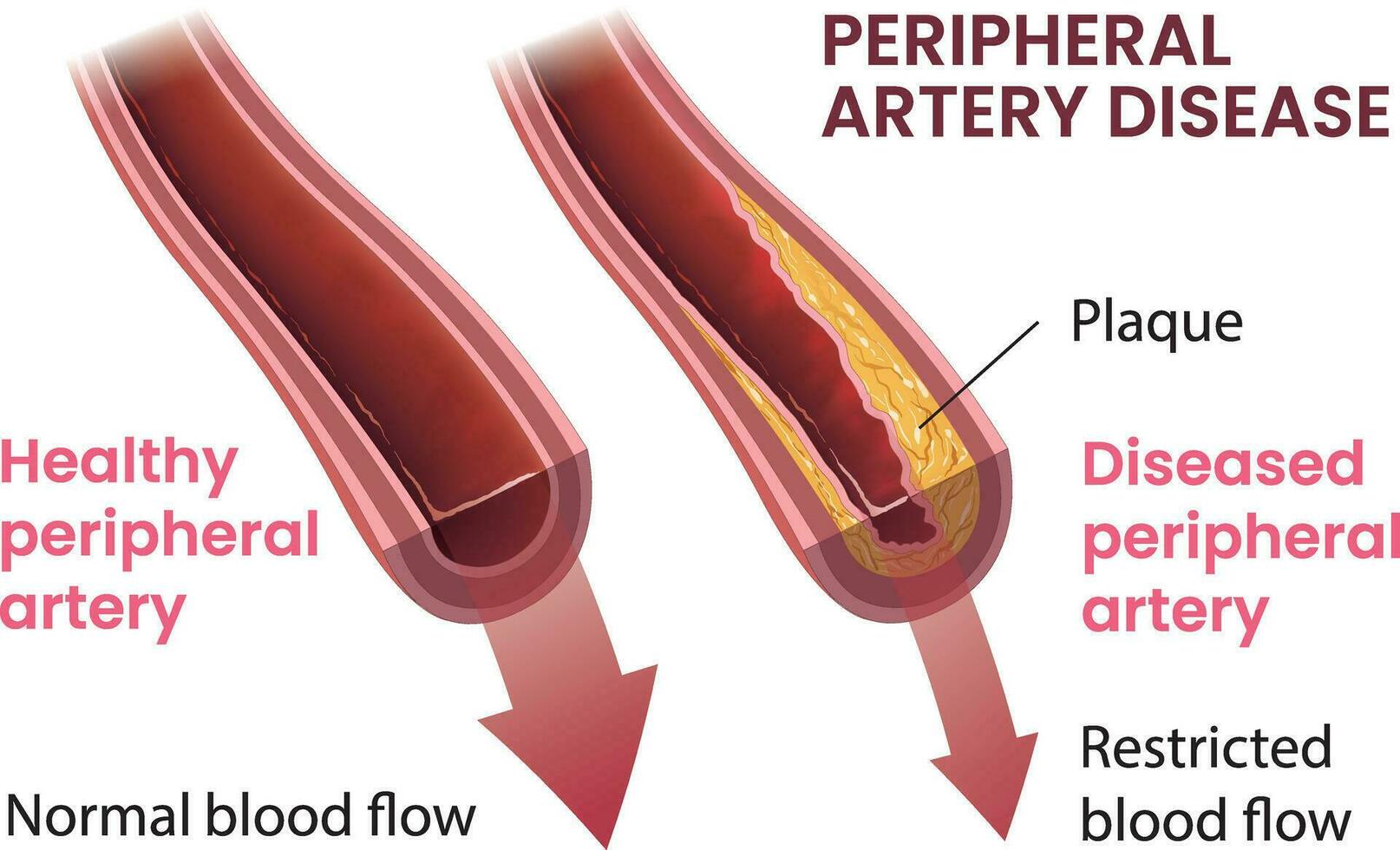 illustrazione di periferica arteria malattia Infografica vettore
