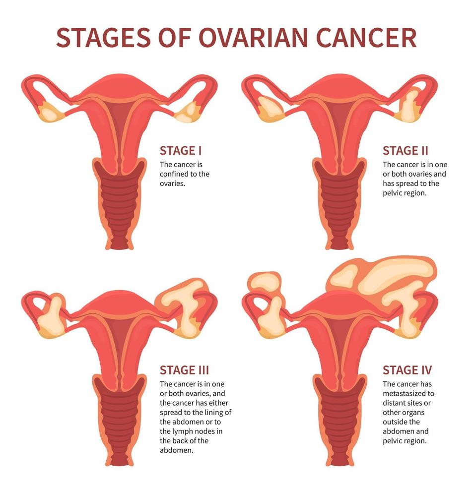 quattro stadi del cancro ovarico della donna isolati vettore