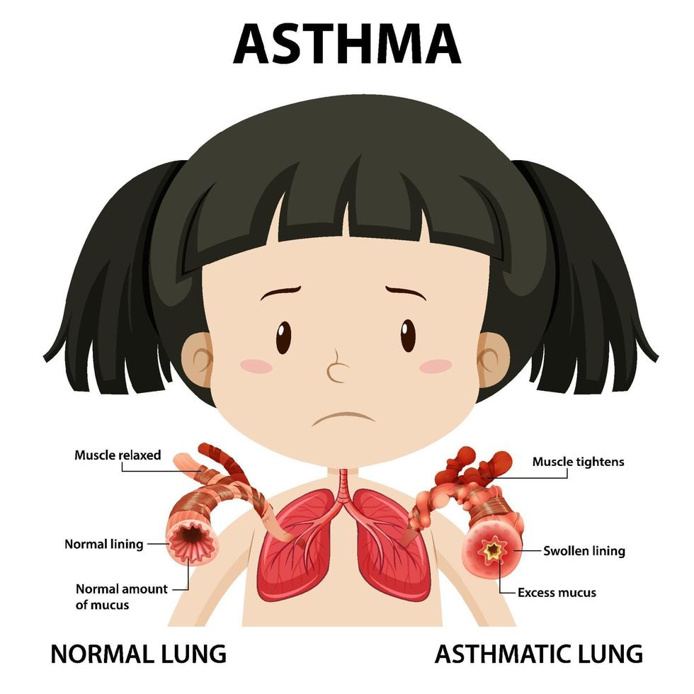 diagramma dell'asma con polmone normale e polmone asmatico vettore