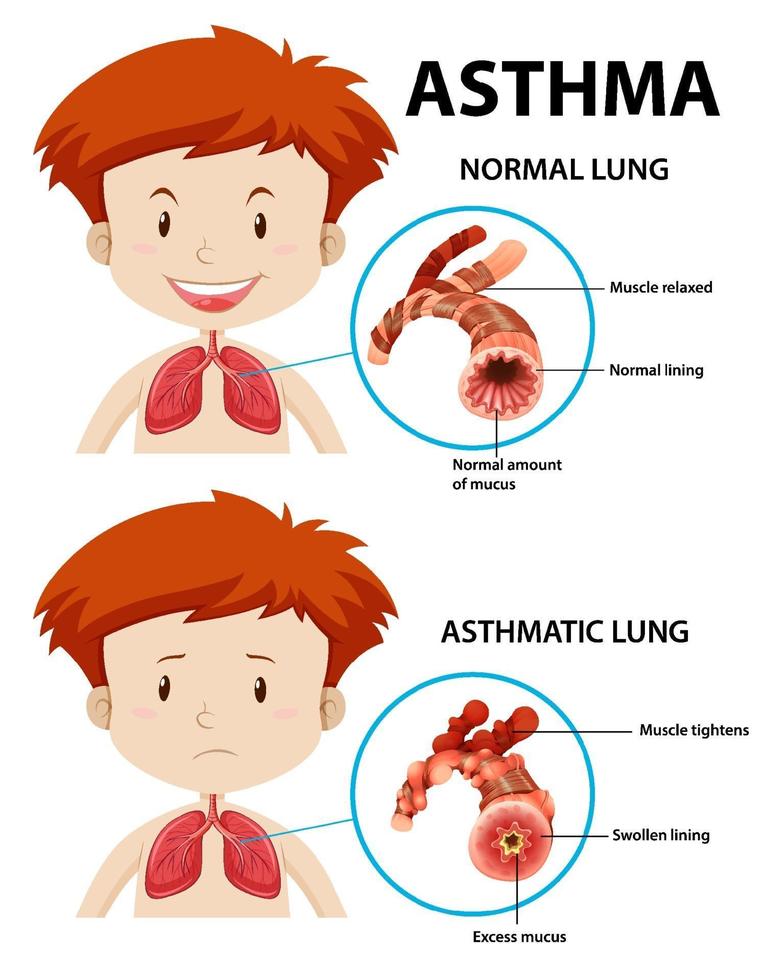 diagramma dell'asma con polmone normale e polmone asmatico vettore