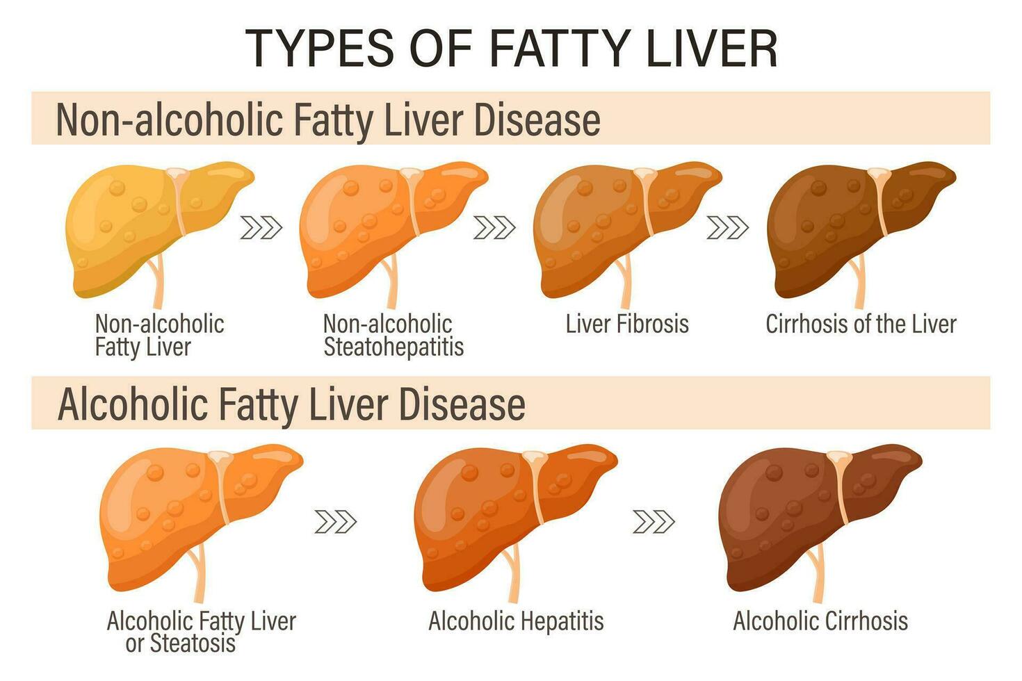 tipi di Grasso fegato. umano fegato malattie. alcolizzato e non alcolico Grasso fegato. epatite, fegato cirrosi, fibrosi, steatosi. medico Infografica striscione. vettore