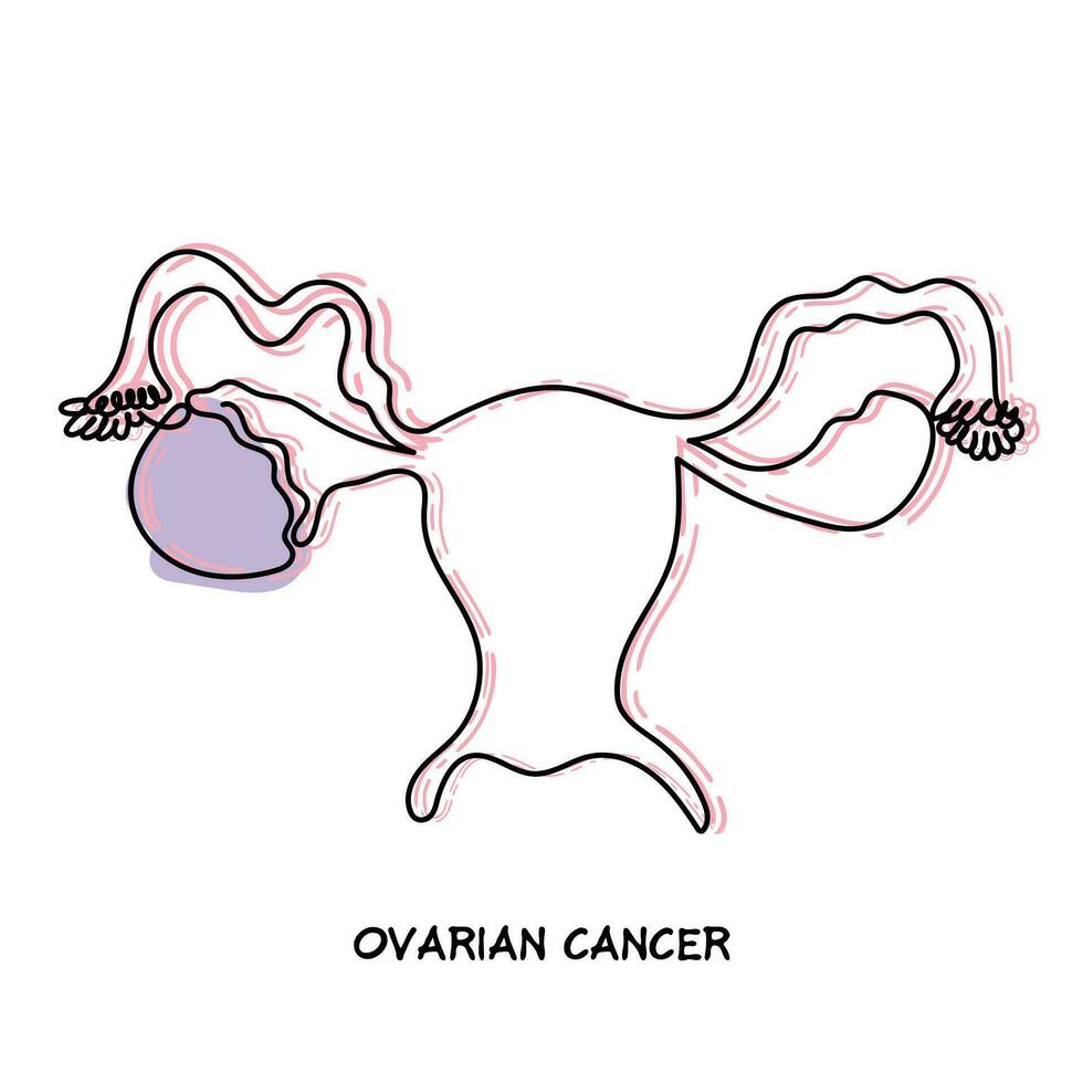 linea arte vettore di ovarico cancro opera d'arte. ovarico cancro clipart