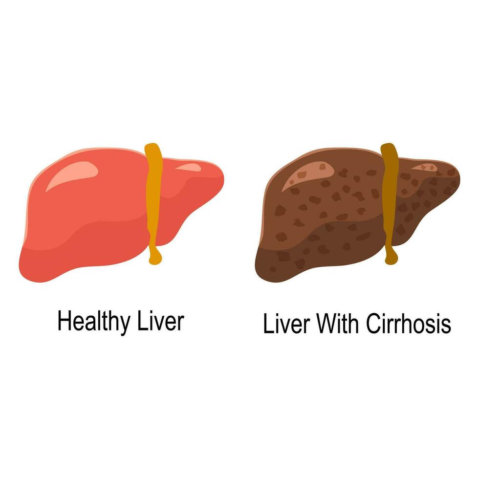 confronto di salutare fegato e fegato cirrosi patologia. medico Infografica bandiera vettore