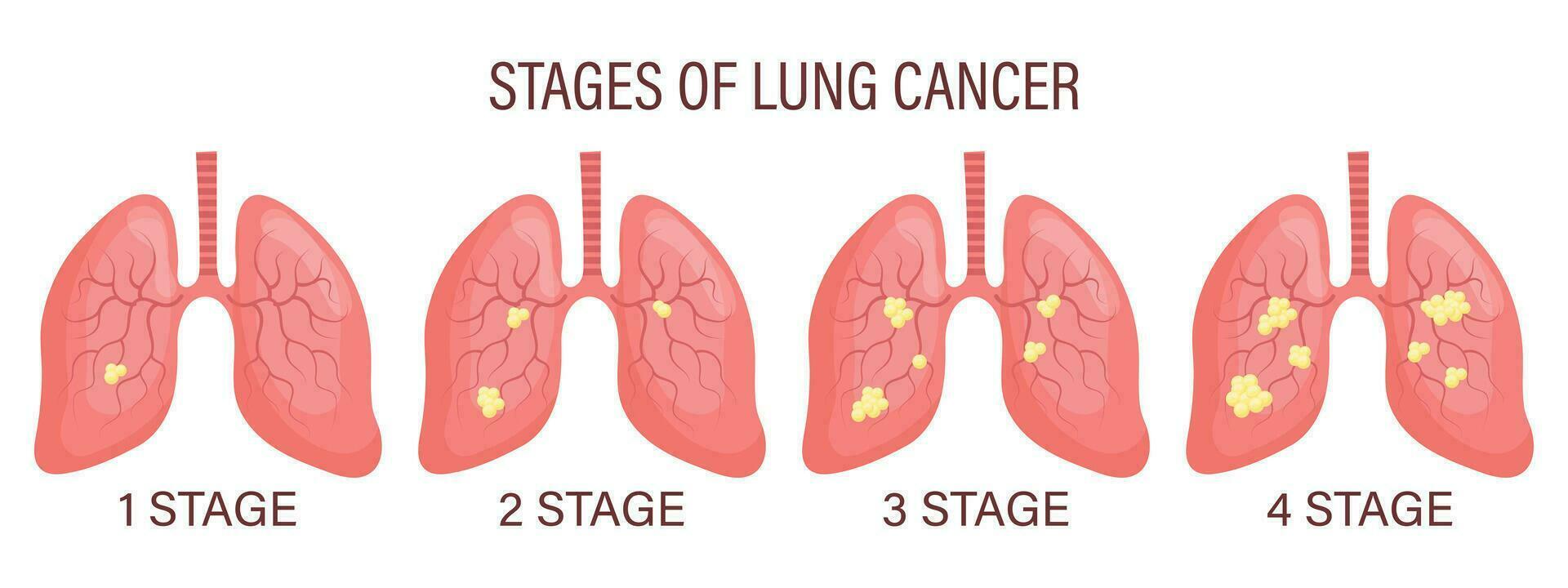 stadi di polmone cancro, polmone patologia. medico Infografica striscione, illustrazione, vettore