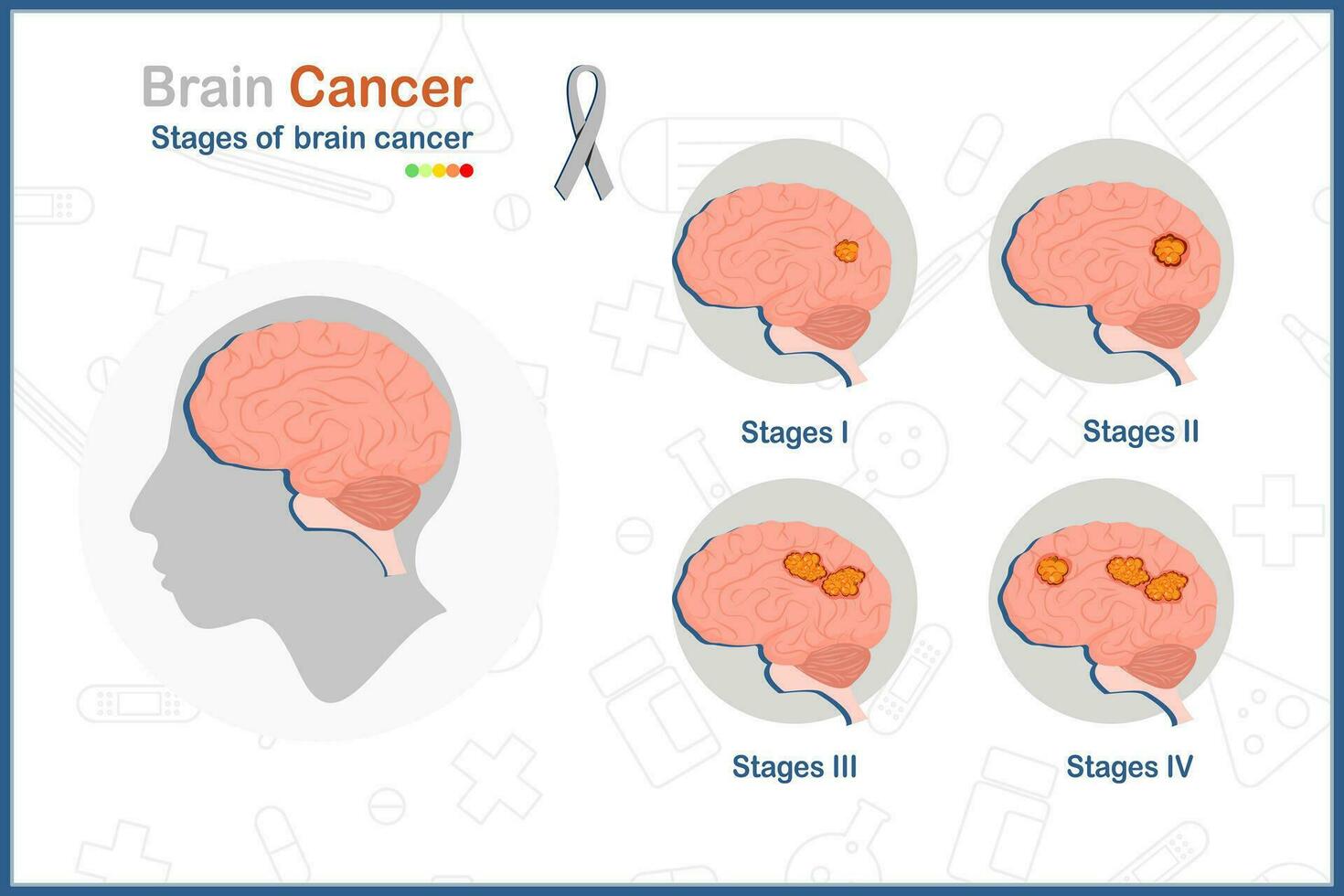 cervello cancro. medico vettore illustrazione nel piatto stile di il quattro stadi di cervello cancro.isolato su bianca sfondo.salute cura e medico concetti.