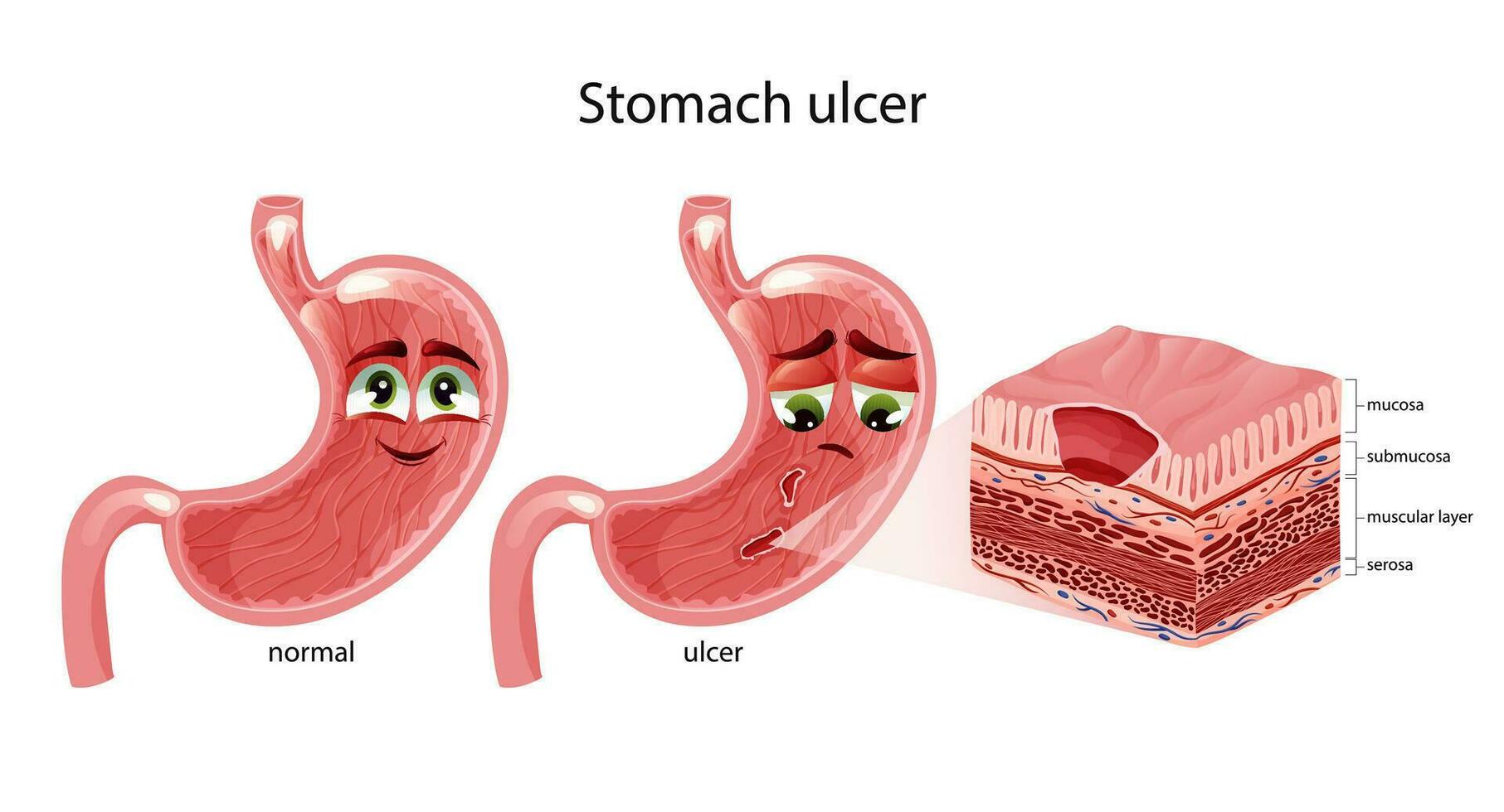 stomaco ulcere. carino contento e triste stomaco personaggi con facce. stomaco attraversare sezione diagramma. anatomico vettore illustrazione