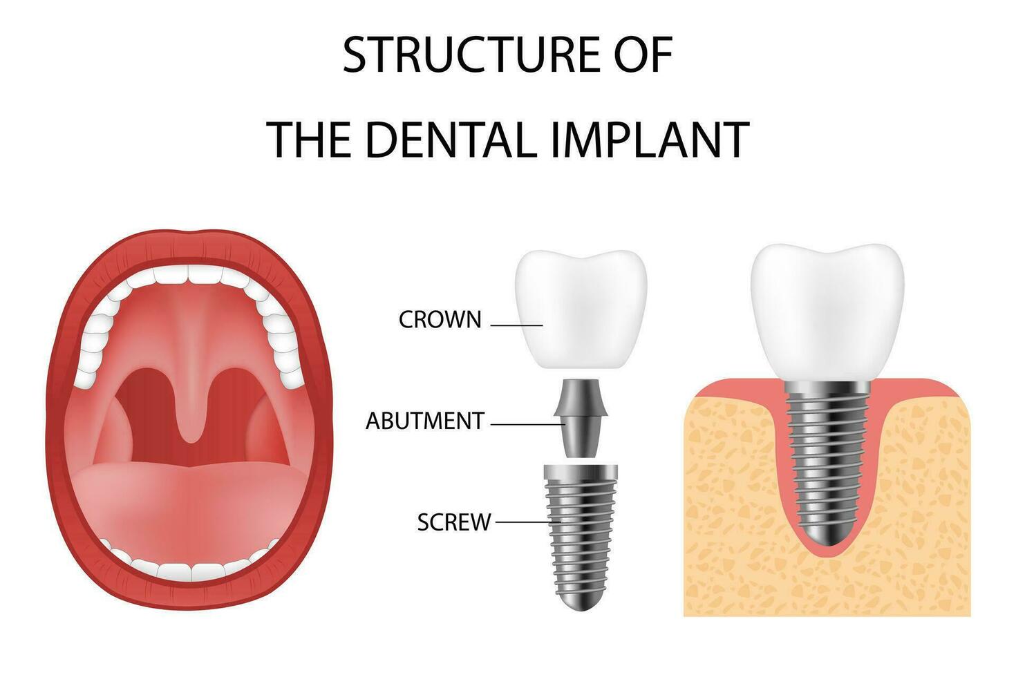 dentale impiantare. realistico impiantare struttura, grafico Modelli di il corona. vite protesi, ortodontico dentale impianto vettore