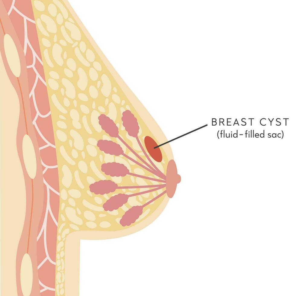 Seno cisti. medico Infografica attraversare sezione di femmina Seno con ascesso. informazione carta. anatomia di donna il petto con infezione. infiammazione di mammario ghiandola. dolore. vettore illustrazione.