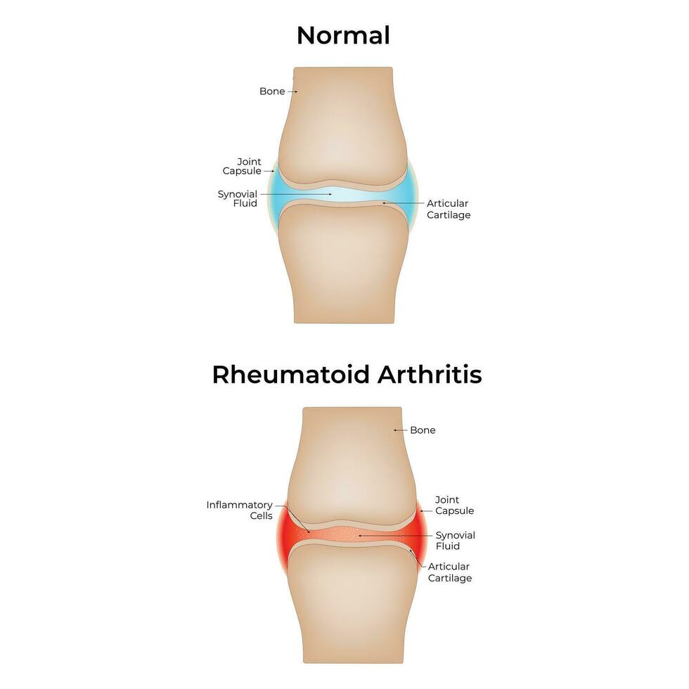 normale e reumatoide artrite scienza design vettore illustrazione