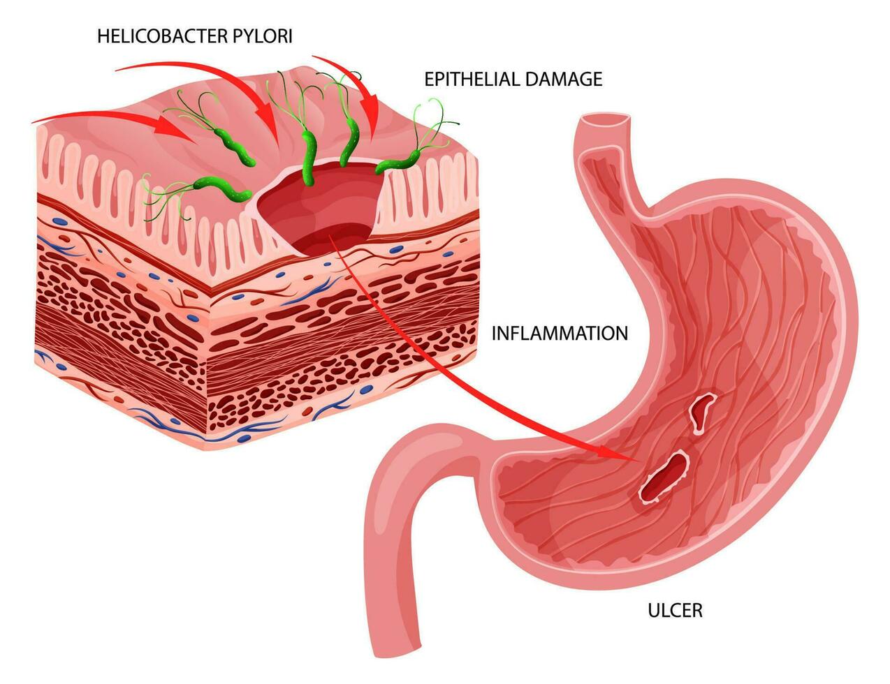 stomaco ulcera causato di helicobacter pylori infezione. vettore