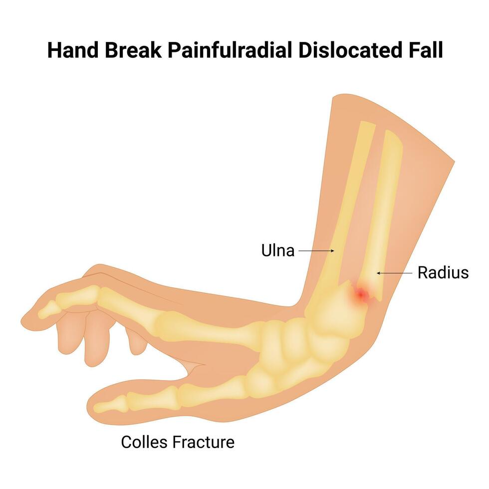 mano rompere dolorosoradiale dislocato autunno scienza design vettore illustrazione