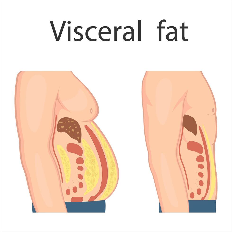 medico manifesto di viscerale Grasso. addominale Grasso circonda il interno porte di il addominale cavità. sovrappeso malattia concetto. peso perdita, liposuzione, e dieta. vettore