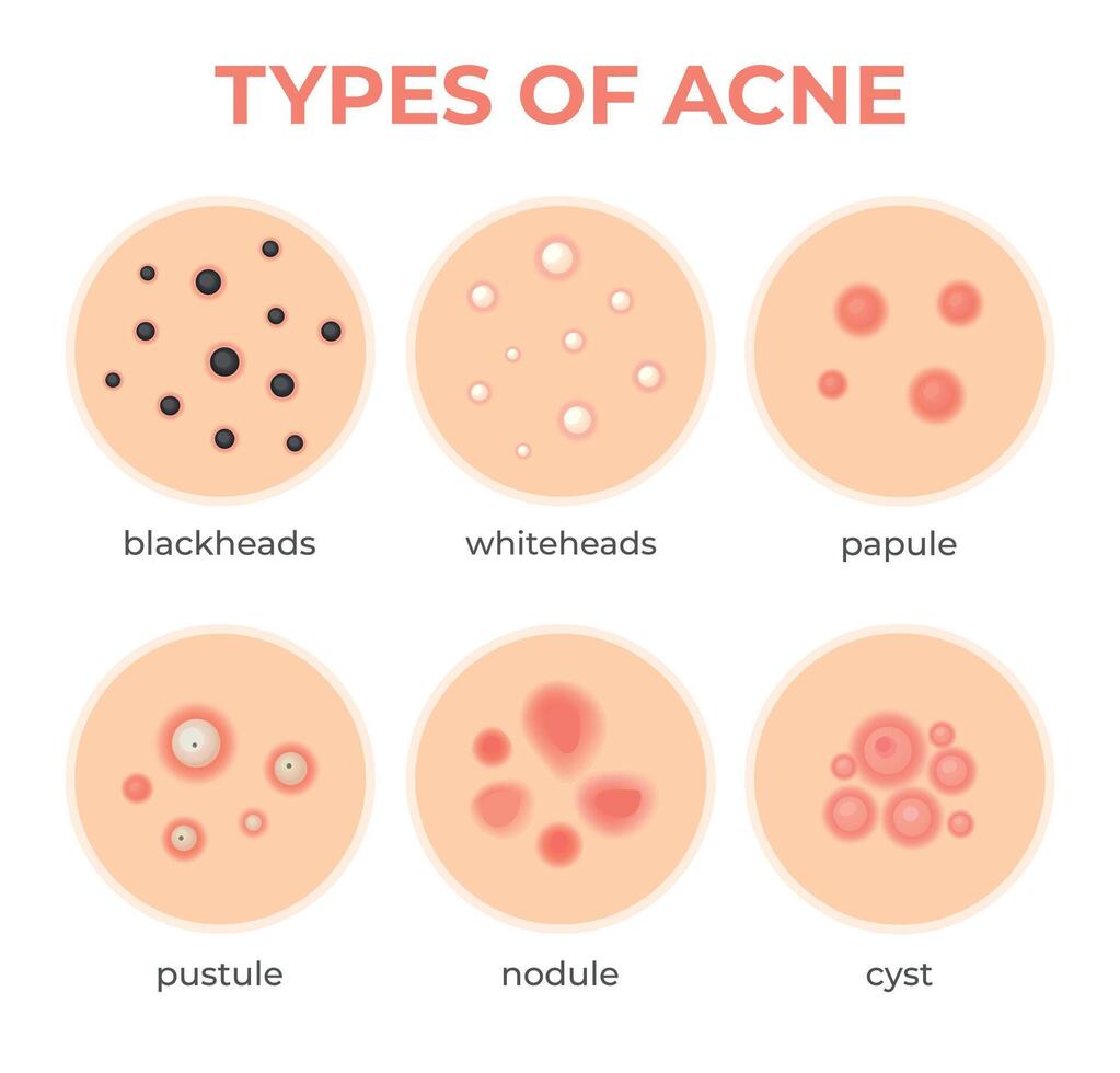 acne tipi. pelle infezione problema, brufoli grado e genere cisti, testa bianca, punti neri, nodulo e cistico. derma poro malattia vettore impostato