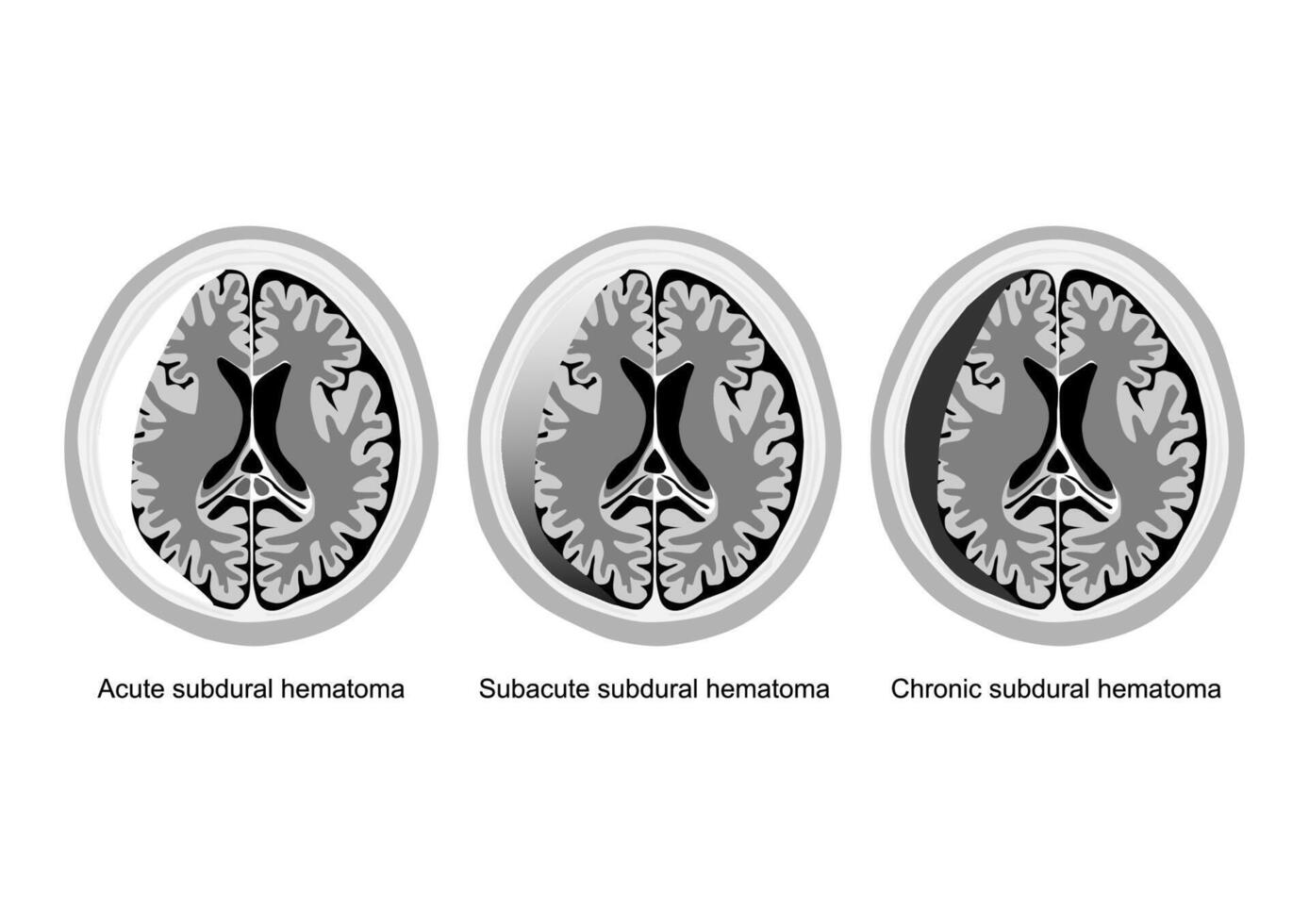 stadi di subdurale ematoma cervello infortunio illustrato. vettore