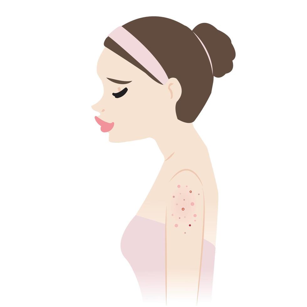 il donna con acne su superiore braccia illustrazione isolato su bianca sfondo. acne, brufoli, punti neri, comedoni, teste bianche, papula, pustola, nodulo e cisti su braccio. pelle problema concetto. vettore