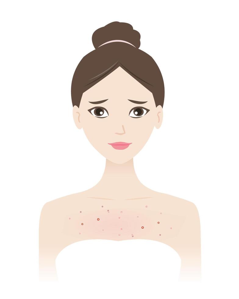 il donna con acne su il petto illustrazione isolato su bianca sfondo. acne, brufoli, punti neri, comedoni, teste bianche, papula, pustola, nodulo e cisti su corpo. pelle problema concetto. vettore