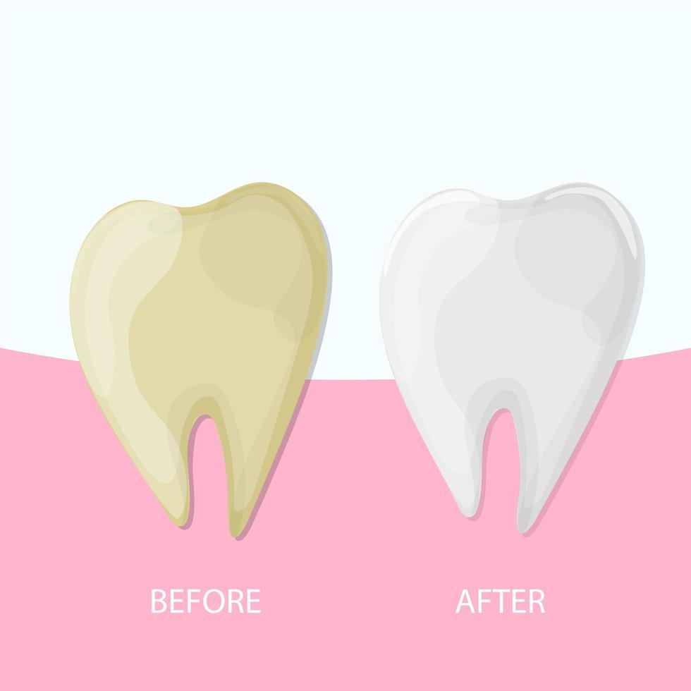 sbiancamento professionale dei denti, dente sano e giallo, illustrazione vettoriale