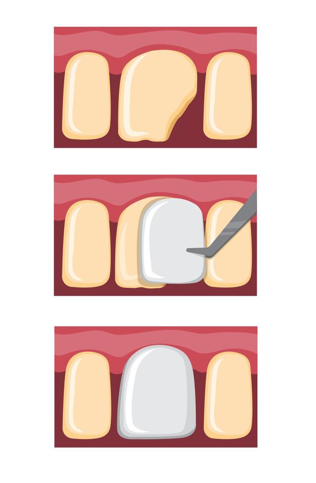 procedura dei denti dell'impiallacciatura, riempimento dentale sul vettore piatto dell'illustrazione del fumetto del dente rotto isolato nel fondo bianco