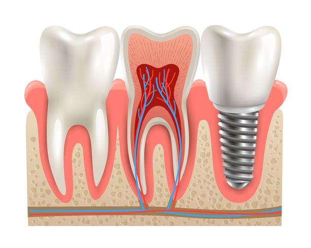 Modello del primo piano di anatomia degli impianti dentali vettore