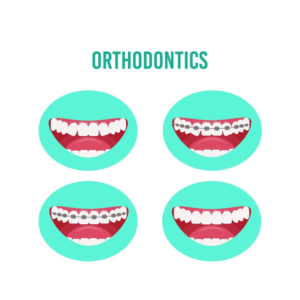 trattamento ortodontico con apparecchi ortodontici, fasi del processo di allineamento dei denti. illustrazione vettoriale in uno stile piatto isolato su uno sfondo bianco.