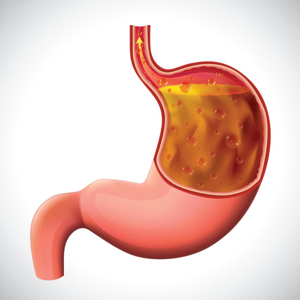 illustrazione della malattia da reflusso gastroesofageo per uso medico ed educativo. vettore