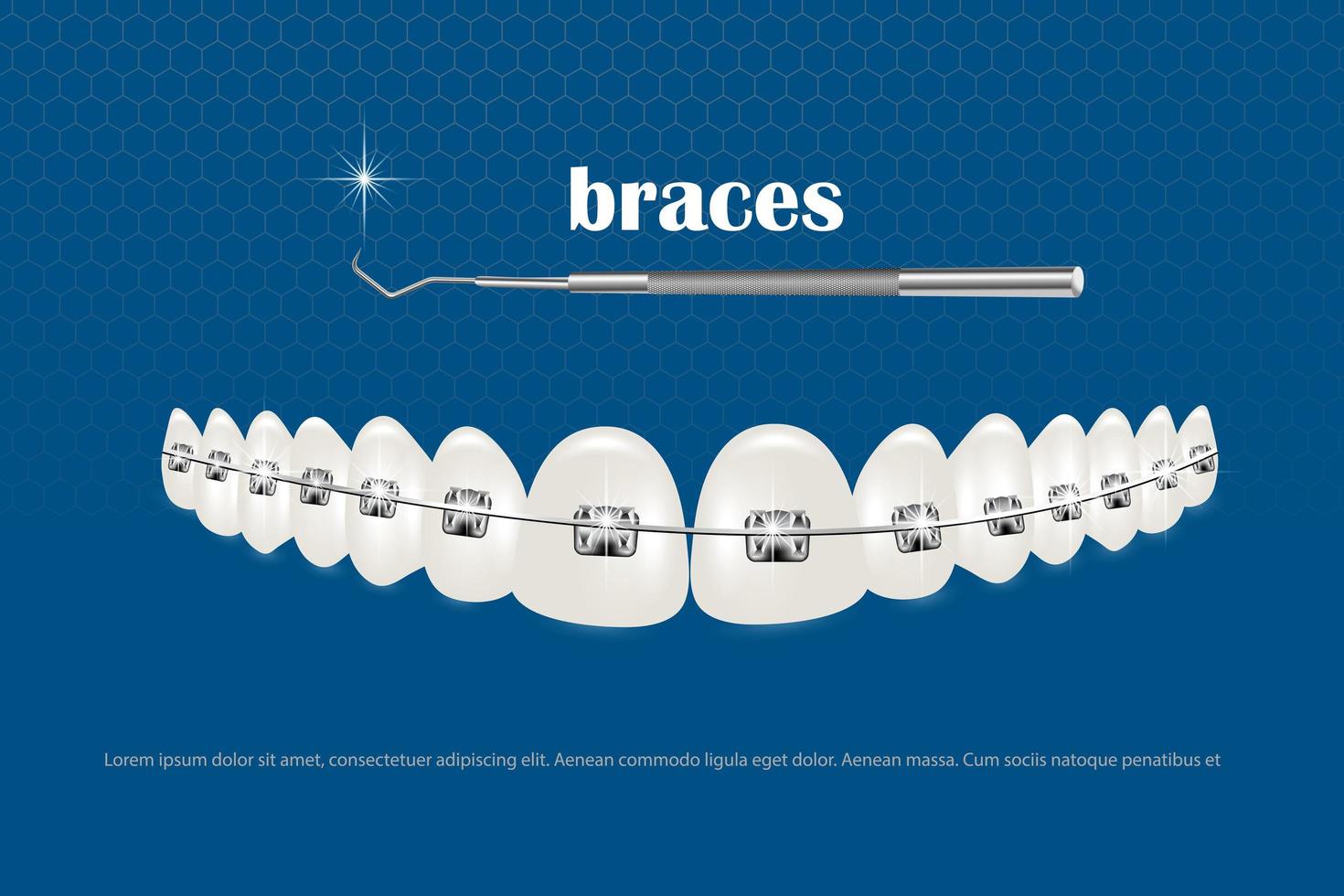 illustrazione vettoriale 3d, denti realistici con parentesi graffe. allineamento del morso dei denti, dentizione con parentesi graffe, apparecchi ortodontici.