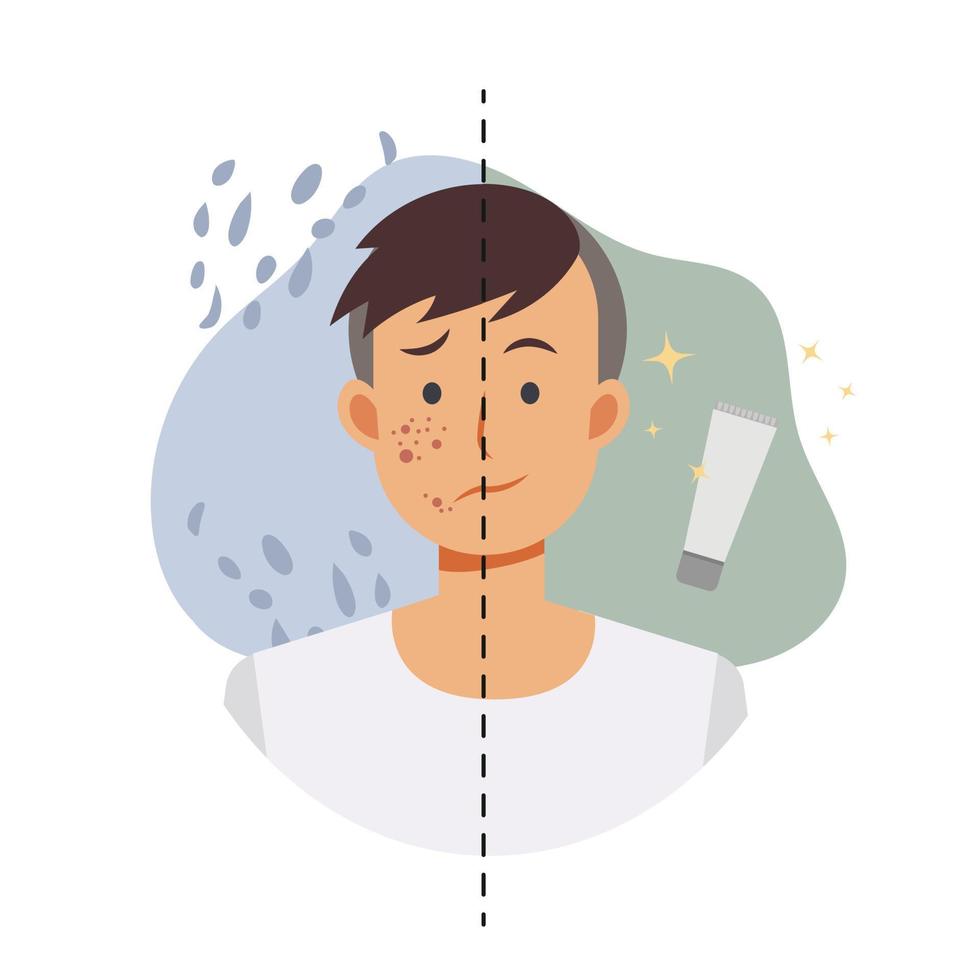 concetto di cura della pelle.trattamento facciale.trattamenti dell'acne carattere maschile.illustrazione vettoriale piatta