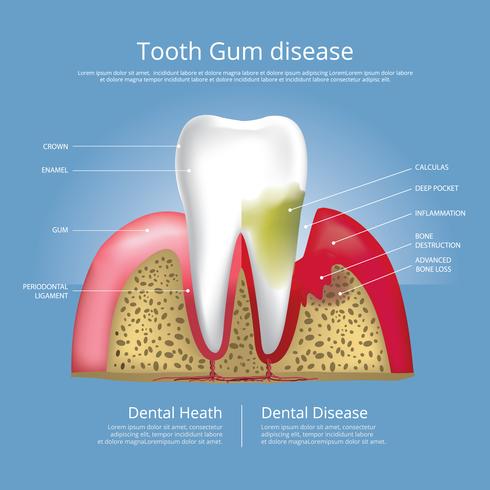 Fasi dei denti umani dell&#39;illustrazione di vettore della malattia di gomma