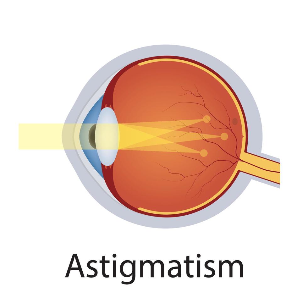 illustrazione di astigmatismo e disturbi della vista. concetto di difetto degli occhi. anatomia dettagliata bulbo oculare con difetto di astigmatismo. vettore isolato