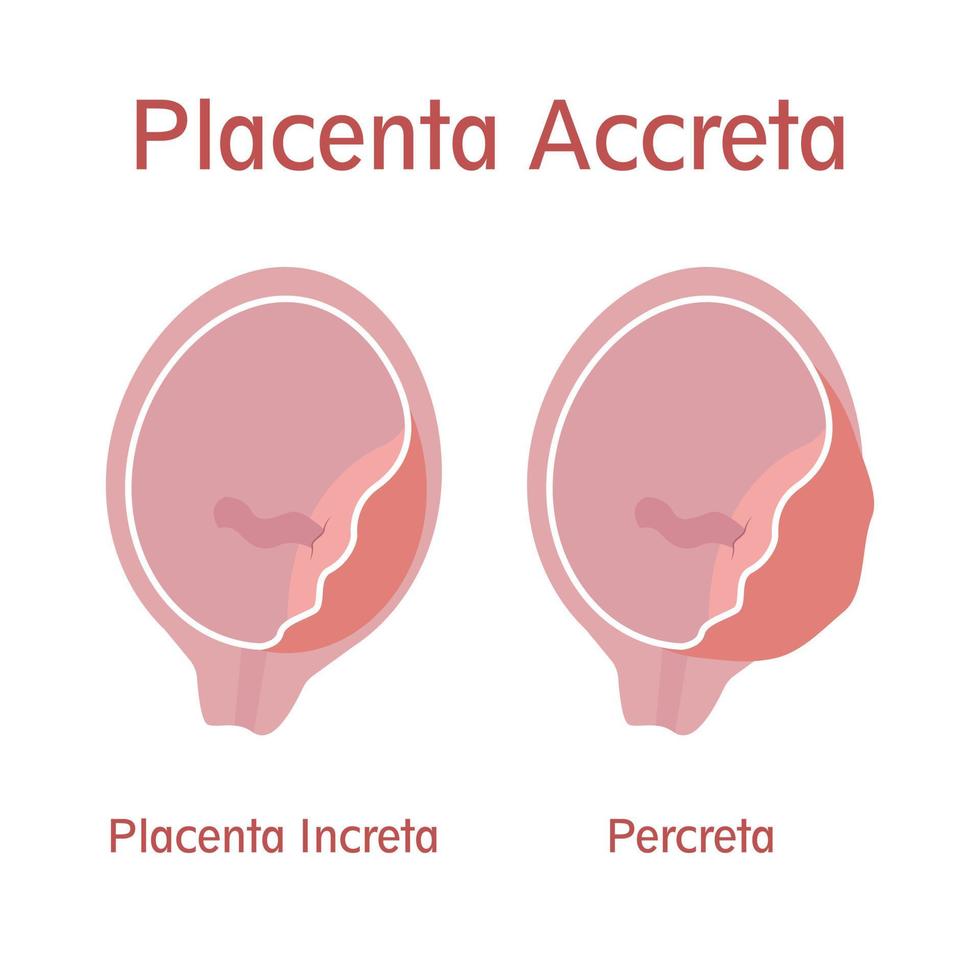 placenta increta e percreta vettore